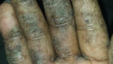 Photo of ‘I couldn’t use my hands’ – Sanitiser delivers pain, depression for Jamaican man