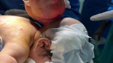 Photo of Baby undergoes successful surgery to remove head-sized mass