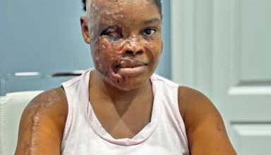 Photo of ‘I forgive him’: Acid attack survivor Jilicia Leitch holds on to faith, seeks surgery in U.S.